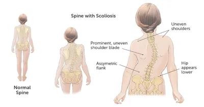 Сколиоз: чем опасно данное заболевание и как с ним бороться