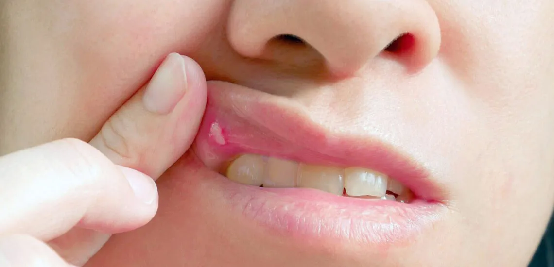 Как вылечить стоматит в Минске. Медикалдент | medicaldent.by Как вылечить стоматит в Минске. Медикалдент | medicaldent.by
