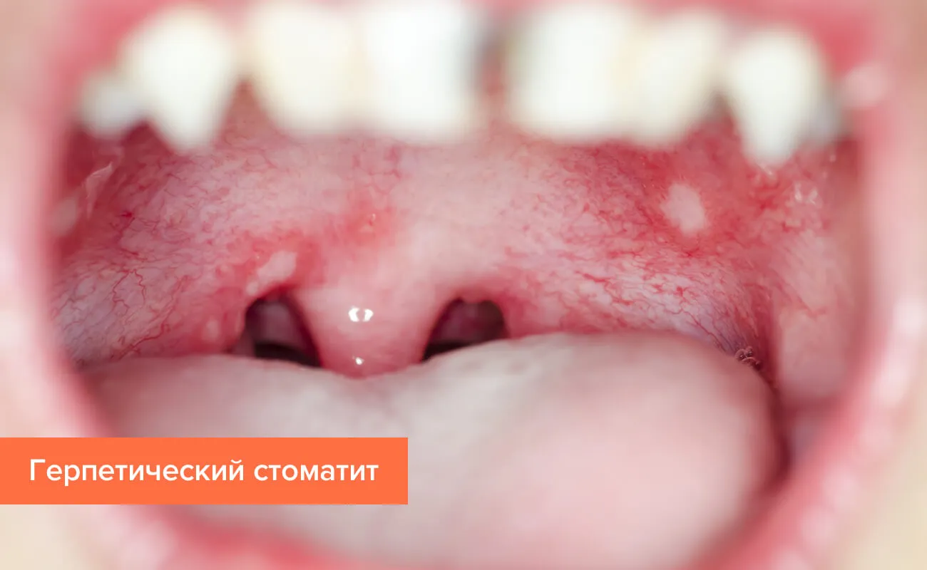 Стоматит – симптомы, лечение, причины, фото Стоматит – симптомы, лечение, причины, фото