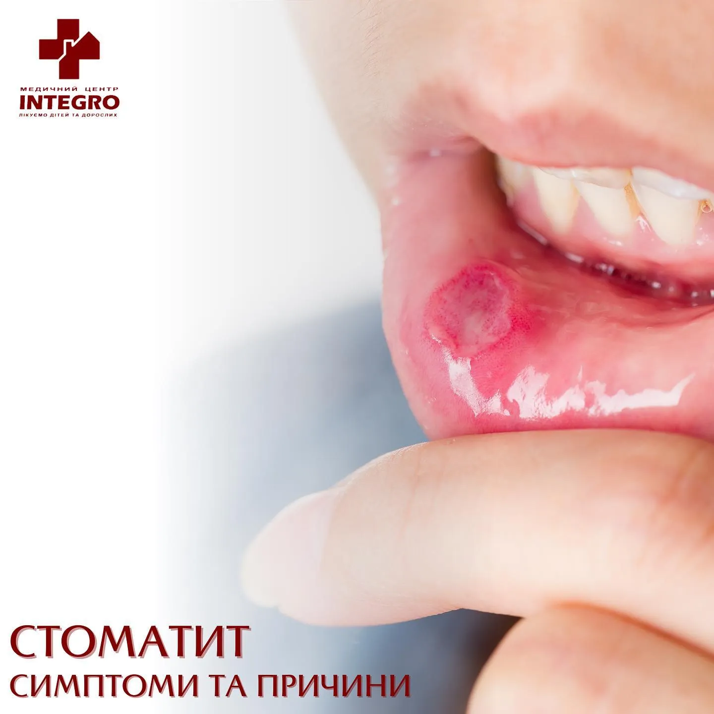 Стоматит – симптомы и причины Стоматит – симптомы и причины