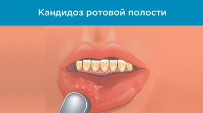 Стоматит – что это, виды, симптомы, лечение у взрослых в «Стоматологии  Комфорта»