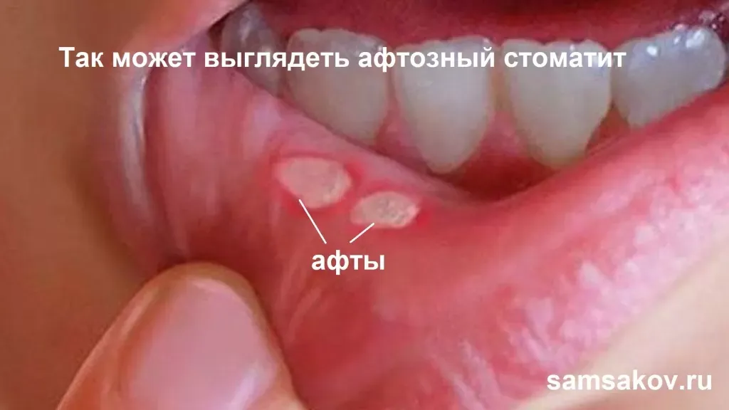 Стоматит — Википедия Стоматит — Википедия