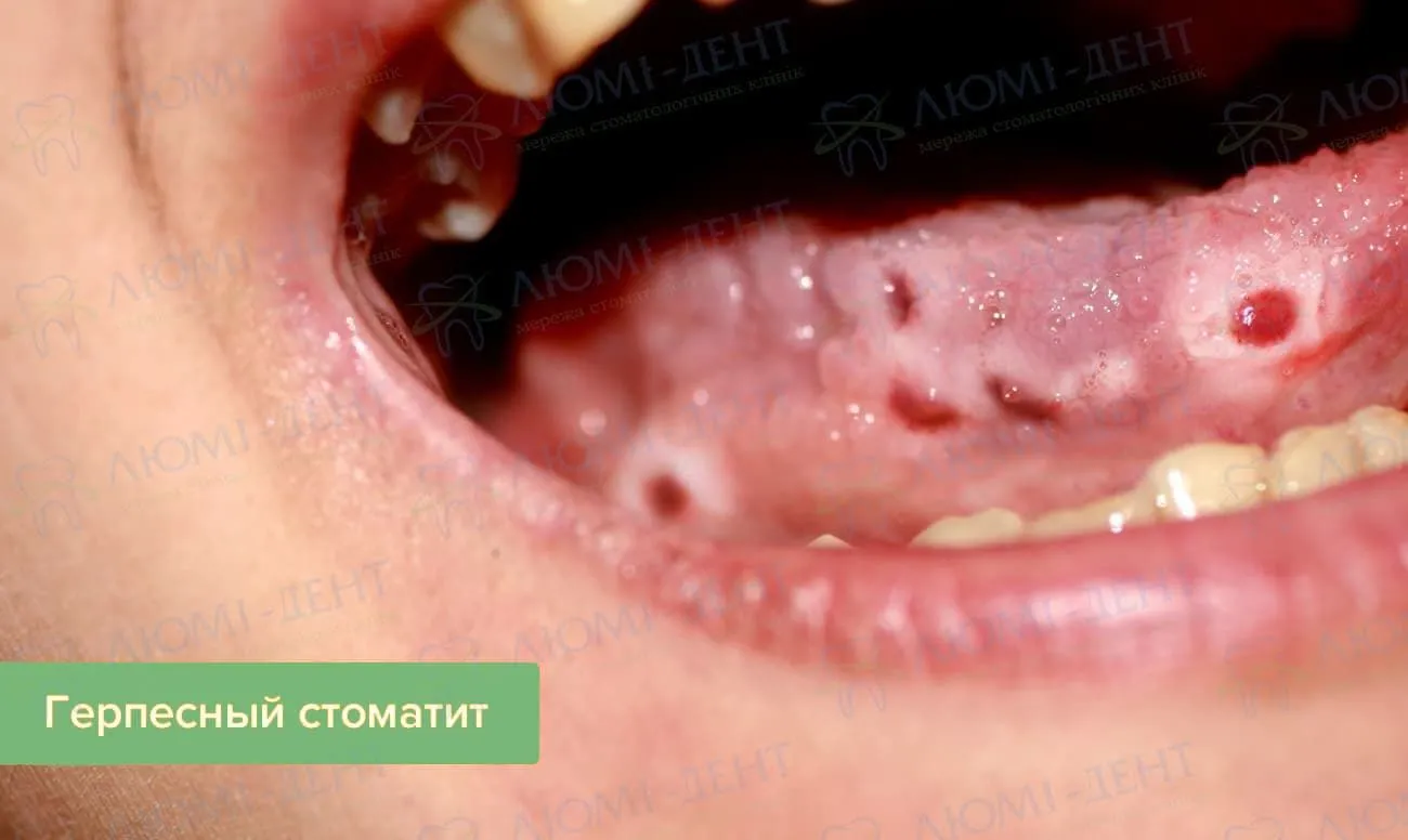 Стоматит - лечение стоматита у детей - Статьи - Стомо.рф - стоматологический портал Красноярска Стоматит - лечение стоматита у детей - Статьи - Стомо.рф - стоматологический портал Красноярска