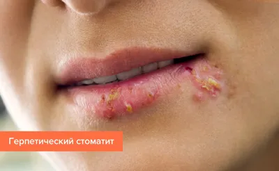 Стоматит. Доступная стоматология и имплантация