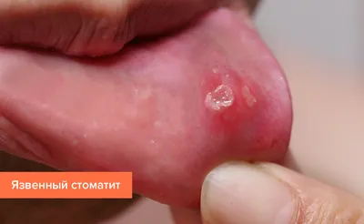 Лечение стоматита у детей – Dentistree