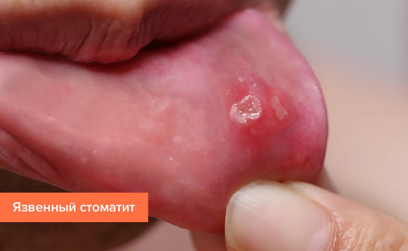 Лечение стоматита у детей – Dentistree Лечение стоматита у детей – Dentistree