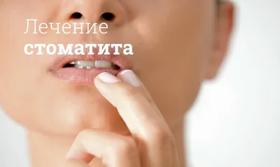 Стоматит - лечение стоматита у детей - Статьи - Стомо.рф -  стоматологический портал Красноярска