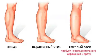 Отличия вальгусной деформации стопы у мужчин и женщин