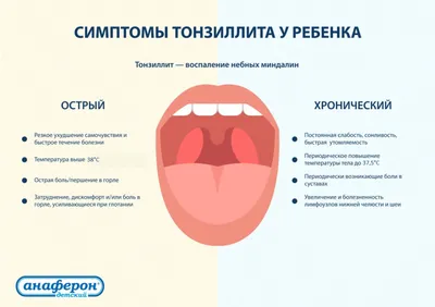 Хронический тонзиллит или болезнь, которой нет | Клиника Рассвет