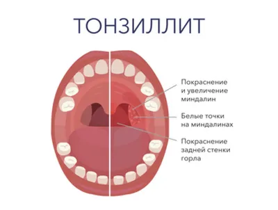 Тонзиллит: симптомы и признаки тонзиллита читайте в статье блога Furasol®