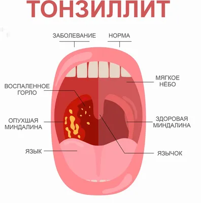 Диагностика и лечение хронического тонзиллита у взрослых и детей