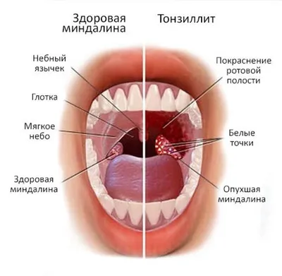 Тонзиллэктомия - операция по удалению миндалин | Лечение тонзиллита