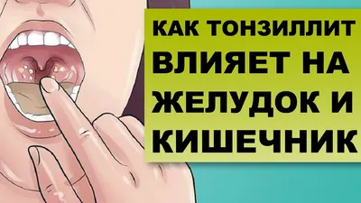 Хронический тонзиллит - признаки, причины, симптомы, лечение и профилактика  - iDoctor.kz