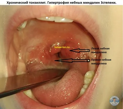 ЛОР центр Сезім - Это надо знать☝️ #Repost @lor_diana_ • • • • • •  Хронический тонзиллит — хроническое воспаление небных миндалин, которое  характеризуется у большинства больных🤕 обострениями и общей аллергической  реакцией.