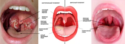 Тонзиллит: виды, причины и лечение - Горизонт - центр медицины