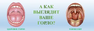 ТОНЗИЛЛИТ и ЖЕЛУДОЧНО-КИШЕЧНЫЙ ТРАКТ - YouTube