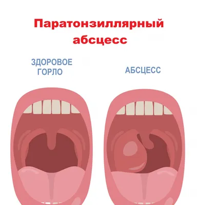 Тонзиллит опасен тяжелыми осложнениями | Ганцавіцкі час