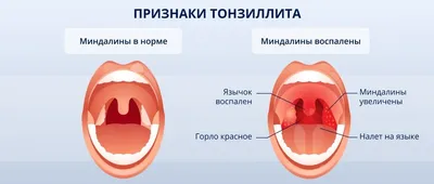 Острый тонзиллит (ангина) у взрослых - симптомы, диагностика, лечение