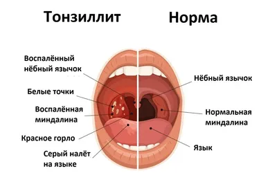 Острый тонзиллит у детей - Клиники Чайка