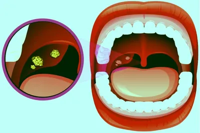 Тонзиллит признаки и лечение у ребенка. Препараты.