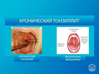 Тонзиллит и его лечение | Врачебная Династия | Дзен