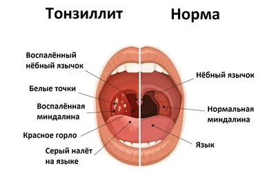 Что такое тонзиллит и как он проявляется? — Статья врача клиники Лайф в  Краснодаре