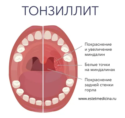 Тонзиллит – Соль Здоровья