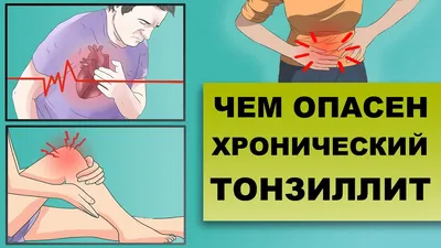 Тонзиллит — что это, причины, симптомы и лечение | Блог | Complimed