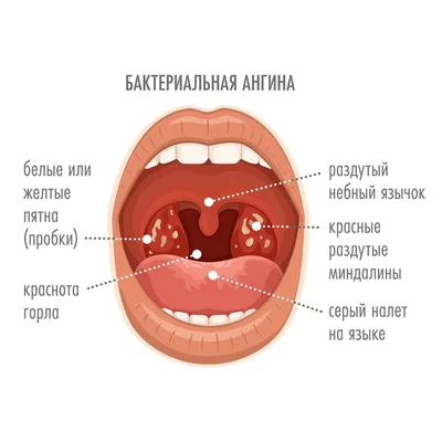 Тонзиллит хронический