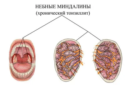 Причины возникновения, признаки и лечение тонзиллита: статьи медцентра  Оксфорд Медикал Винница