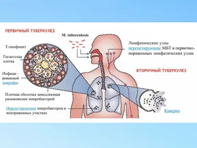 Туберкулез — болезнь без социальных границ — Горловка