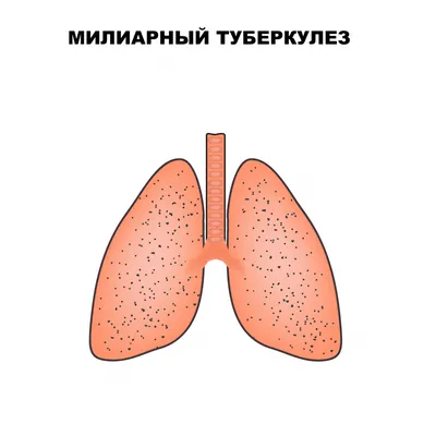 Туберкулез. Заболевания.