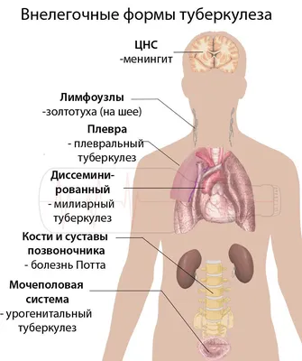 Туберкулез: будьте бдительны! - Бердюжье медиа. Новости Бердюжского района