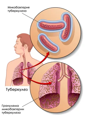 Туберкулез и рак легких, как отличить туберкулез от рака лешкого |  Patient-mt.ru