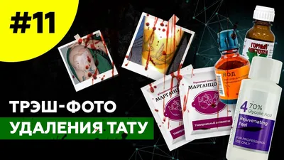 Эффективное удаление татуировки йодом: фото до и после