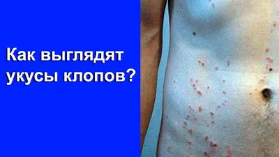 Дезинфекция Астана - 🔰 Постельные клопы являются ночными насекомыми,  которые питаются в основном ночью, когда жертва спит. Днём, они прячутся в  щелях и трещинах стен, кроватей, мебели, в основном в тех местах,
