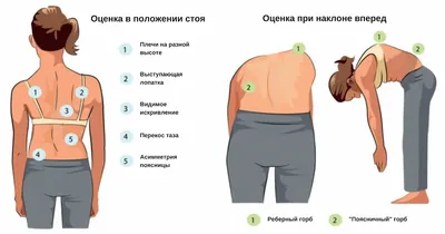 10 лучших упражнений при сколиозе у взрослых: комплекс эффективных  тренировок для укрепления мышц спины