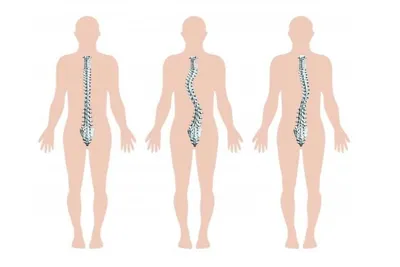 Комплекс упражнений ЛФК при сколиозе