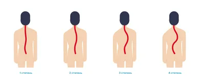 S-Образный сколиоз 1-2-3 степени, причины, лечение грудо-поясничного отдела  позвоночника