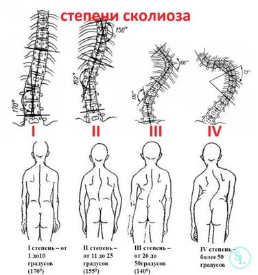 Корсет Для Лечения Сколиоза — стоковые фотографии и другие картинки Сколиоз  - Сколиоз, Корсет, Физиотерапия - iStock