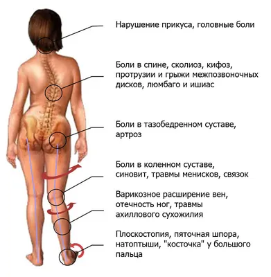 Анатомия - ПЛАВАНИЕ НЕ ЛЕЧИТ СКОЛИОЗ Исследование от института изучения и лечения  сколиоза (ISICO, Италия), перевод: Nina Samsonova Rudenko Плавание не  является методом лечения сколиоза. Напротив, если плавание практикуется в  интенсивном режиме,