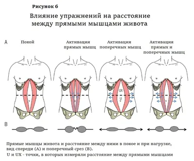 Диастаз прямых мышц