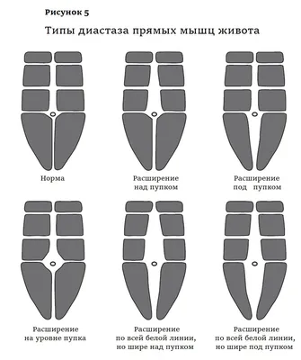 Диастаз прямых мышц живота | Александр Маркушин пластический хирург