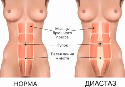 Абдоминопластика с ушиванием диастаза в Москве - цены в Damas Clinic |  Стоимость проведения абдоминопластики