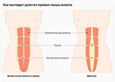 Лечите ли вы диастаз прямых мышц живота? - Евразийский центр бариатрии