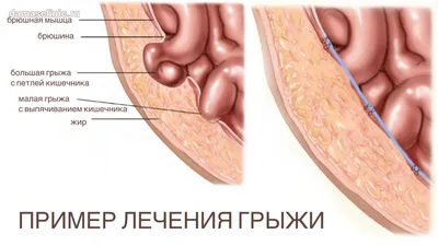 Диастаз прямых мышц живота - KinesioPro