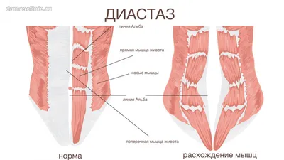 Упражнение при диастазе — тренировки для пресса при диастазе мышц живота