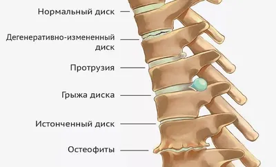 Дегенеративные заболевания позвоночника (2021). Клинические рекомендации.