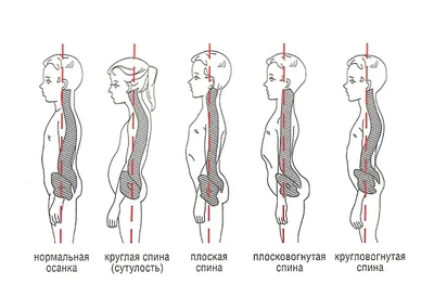 Какие упражнения нельзя делать при кифозе, 5 противопоказанных упражнений -  Чемпионат