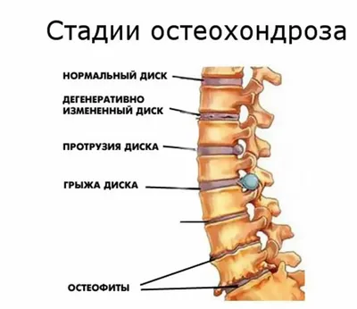 Остеохондроз: истории из жизни, советы, новости, юмор и картинки — Все  посты, страница 3 | Пикабу